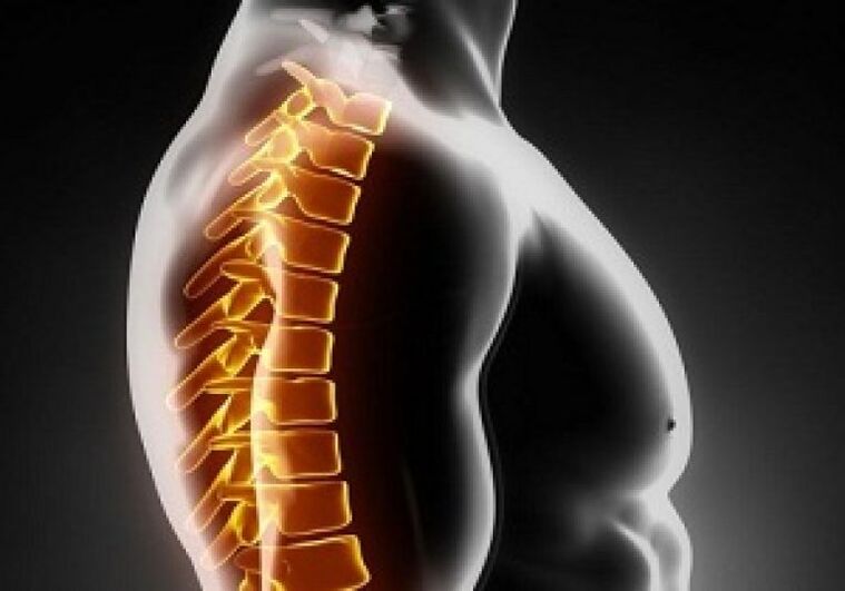 Die thorakale Osteochondrose geht mit Schmerzen und Beschwerden in der Mitte des Rückens einher