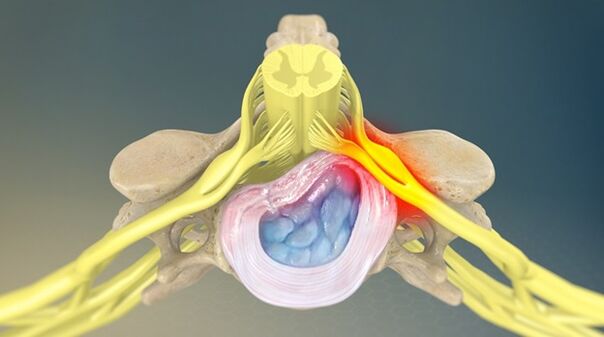 Radikuläres Syndrom als Ursache für Schmerzen im unteren Rückenbereich